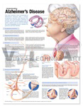 Understanding Alzheimer's Disease Anatomical Chart, Second Edition